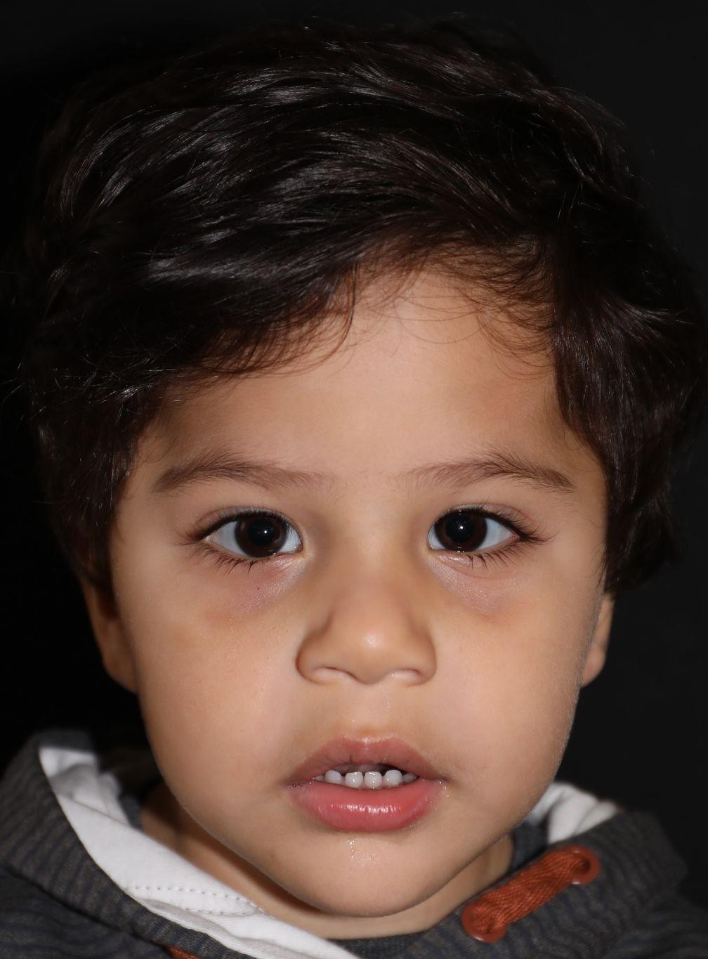 Front view at Year 3 after treatment - Case 1006