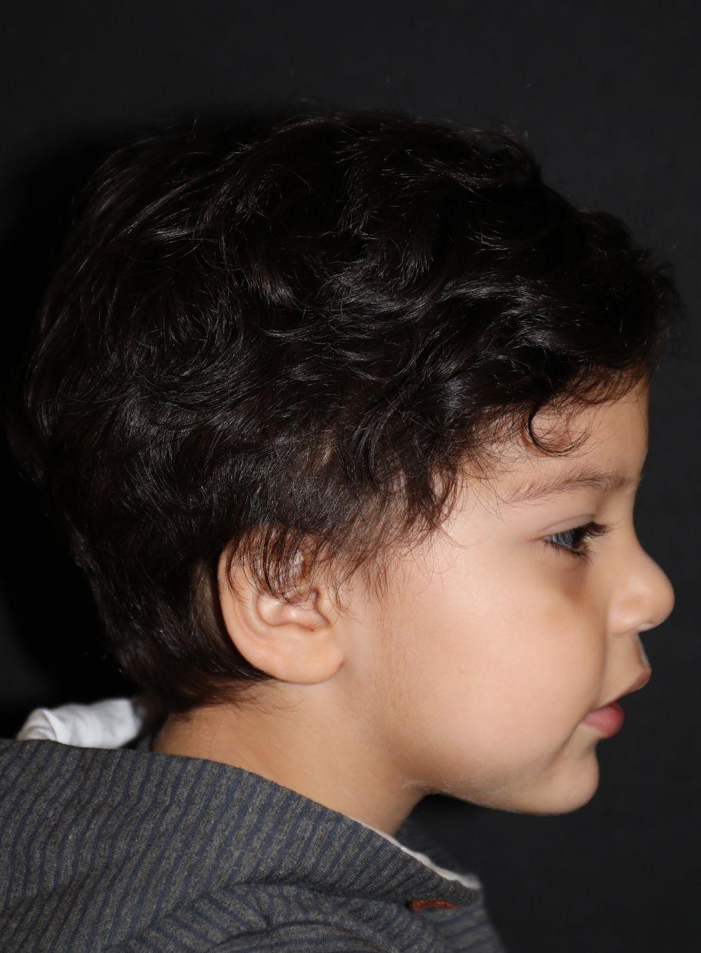 Right profile at Year 3 after treatment - Case 1006