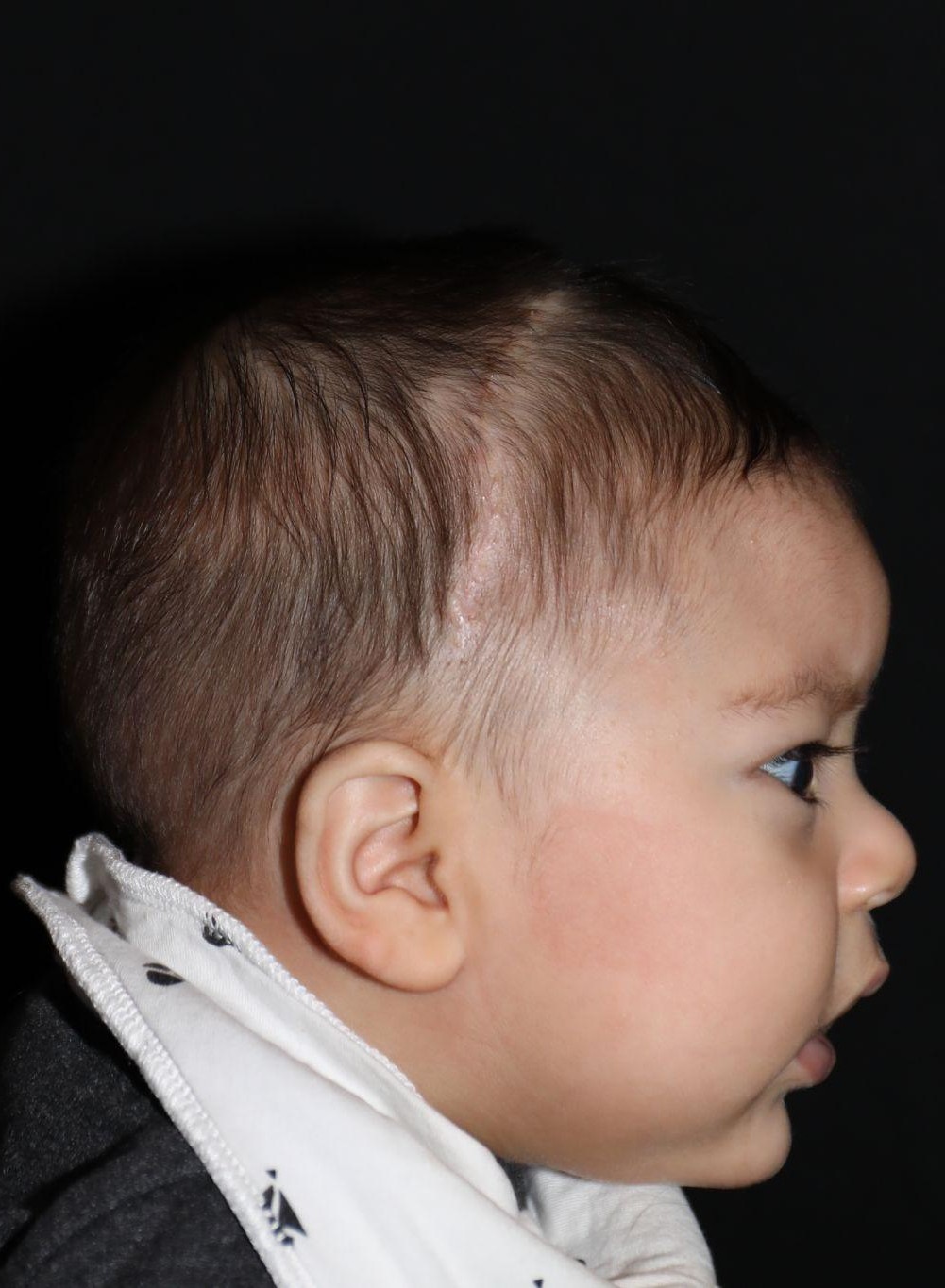 Right profile at Year 2 after treatment - Case 1006
