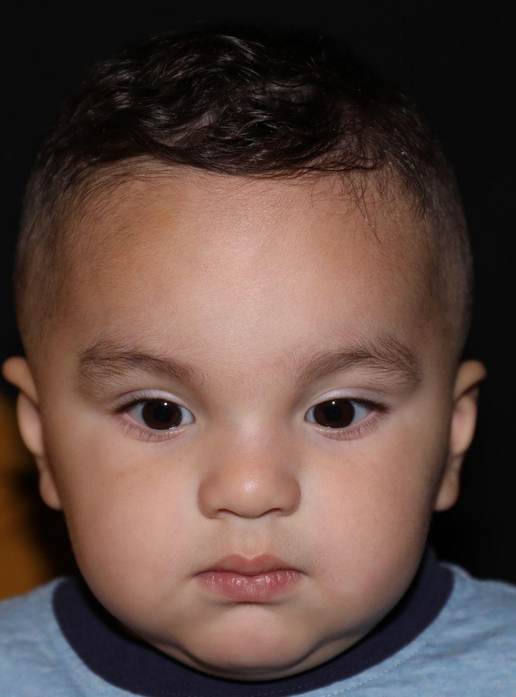 Front view at Year 2 after treatment - Case 1007