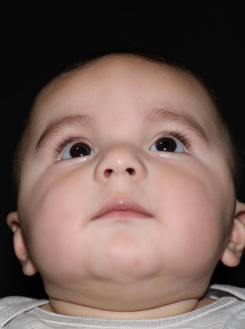 Chin before treatment - Case 1007