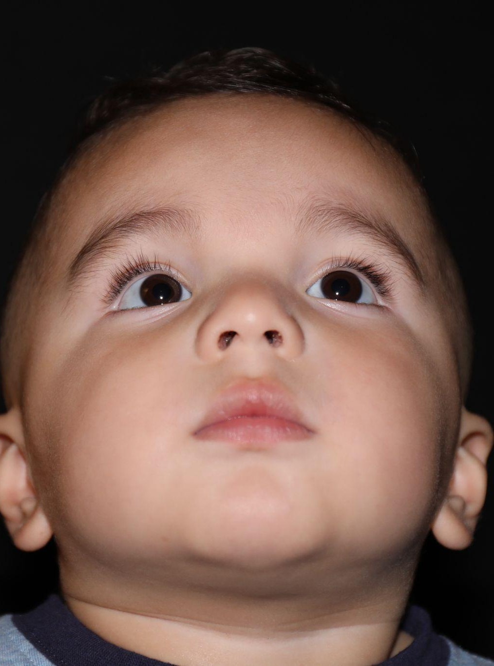 Chin at Year 2 after treatment - Case 1007