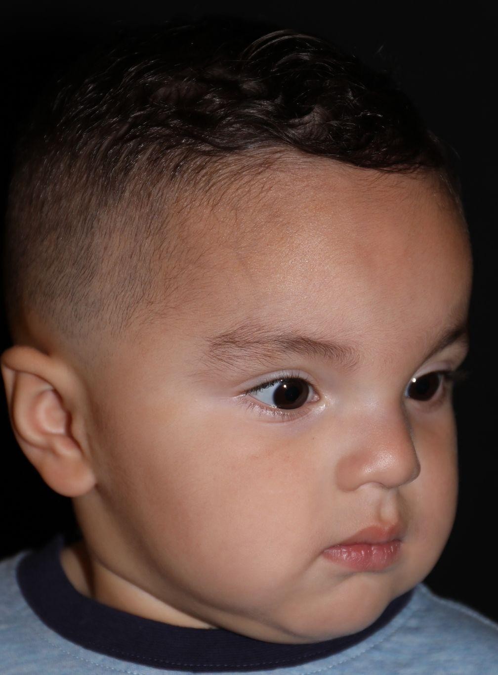 Right angle at Year 2 after treatment - Case 1007