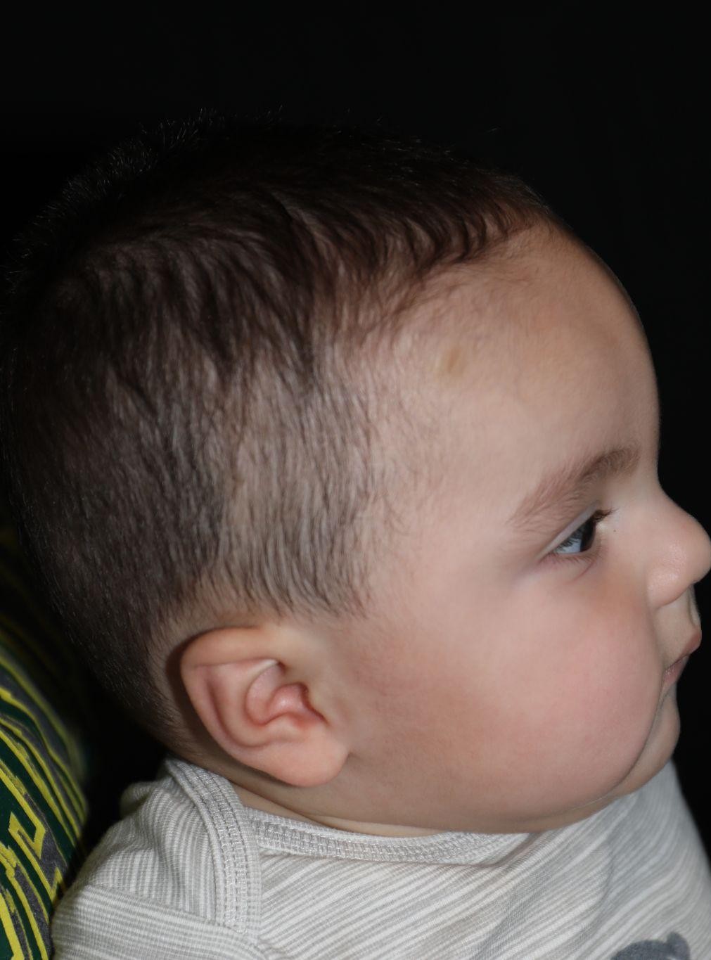 Right profile before treatment - Case 1007