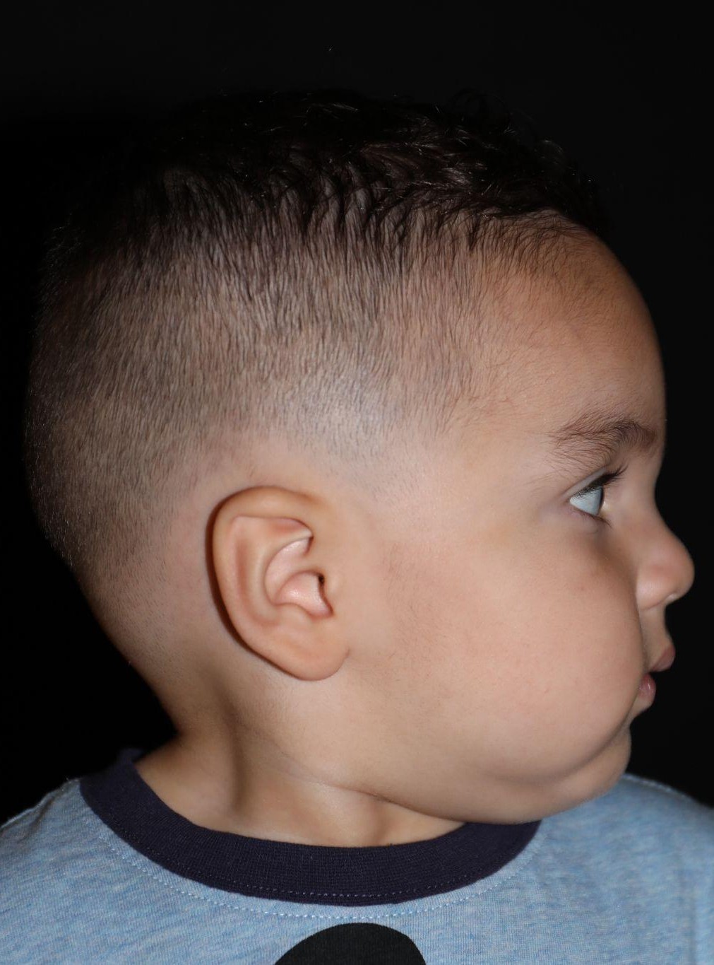 Right profile at Year 2 after treatment - Case 1007