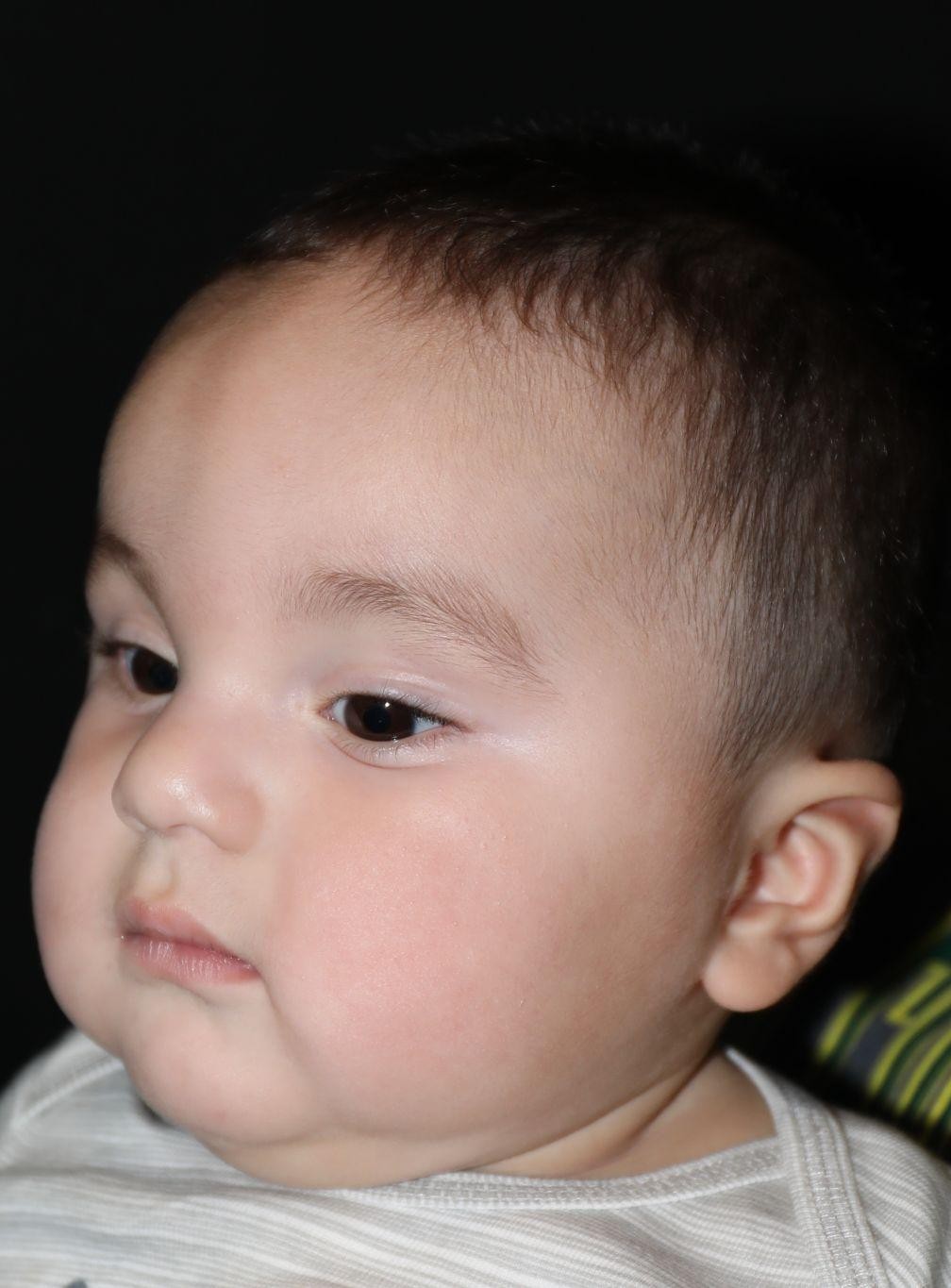 Left angle before treatment - Case 1007