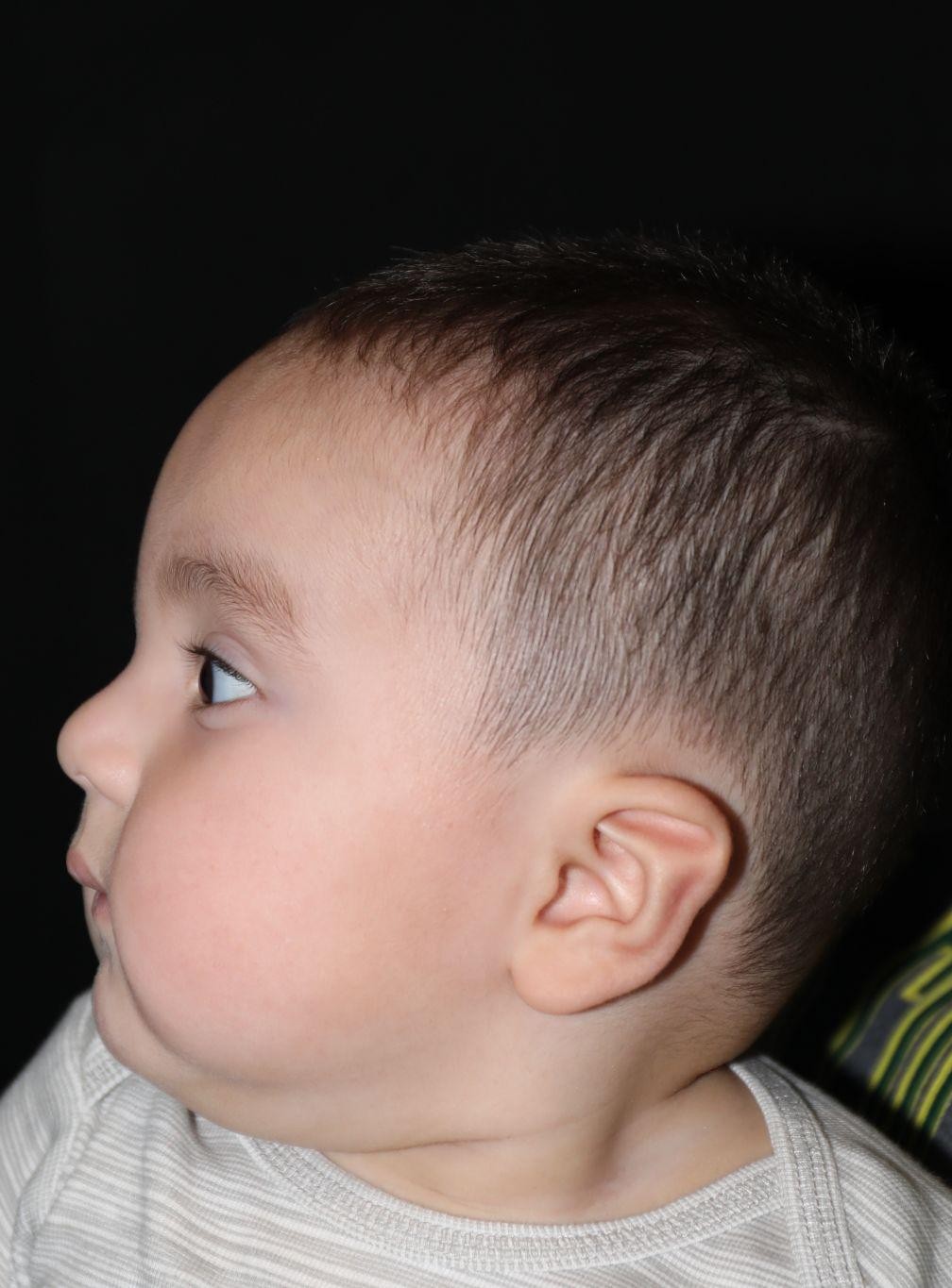 Left profile before treatment - Case 1007