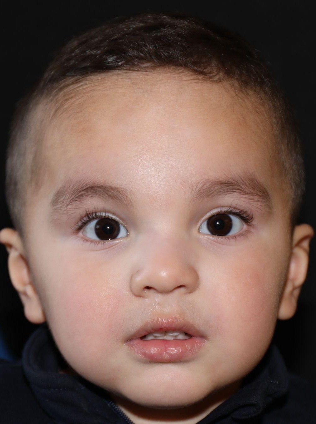 Front view at Year 3 after treatment - Case 1007