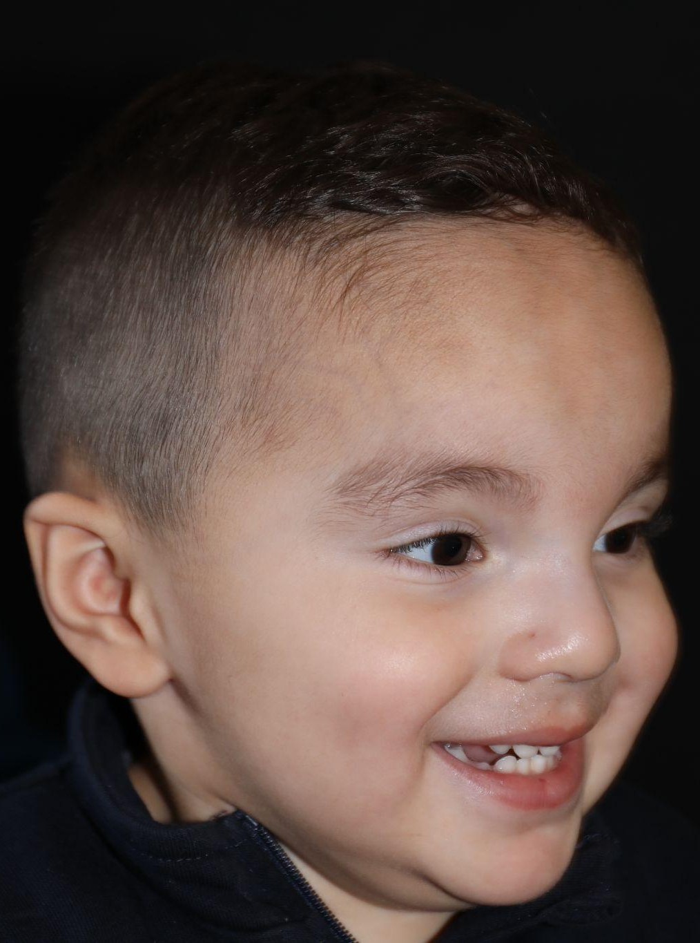 Right angle at Year 3 after treatment - Case 1007