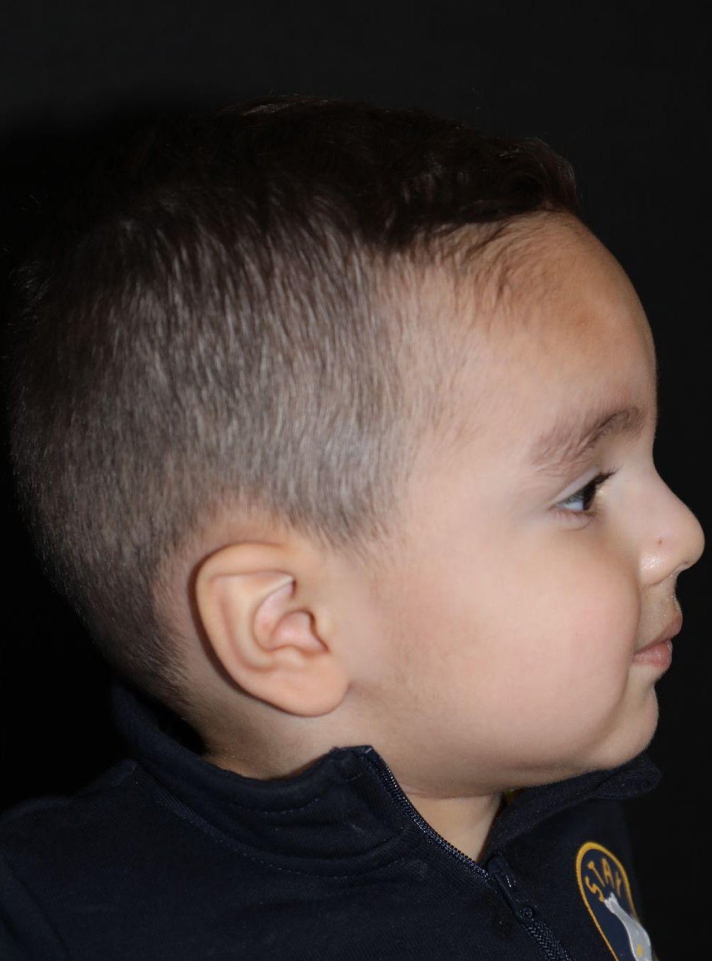 Right profile at Year 3 after treatment - Case 1007