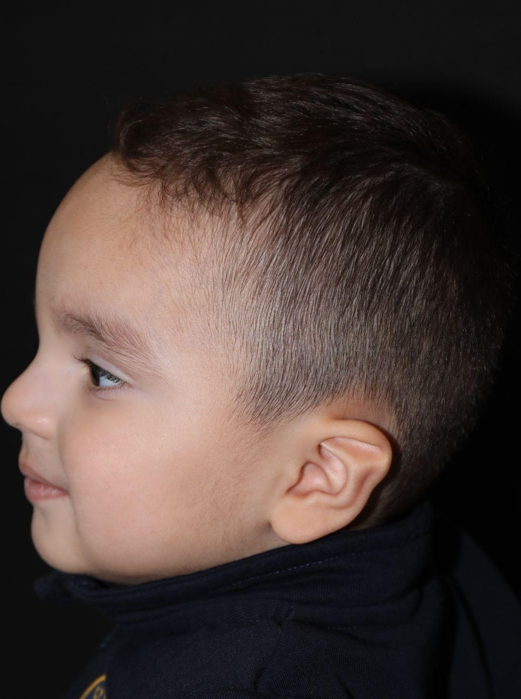 Left profile at Year 3 after treatment - Case 1007