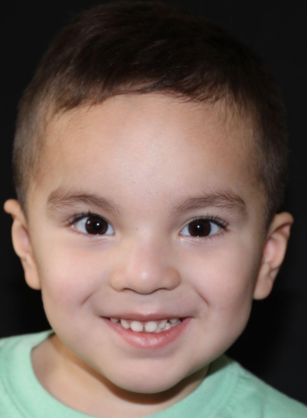 Front view at Year 4 after treatment - Case 1007