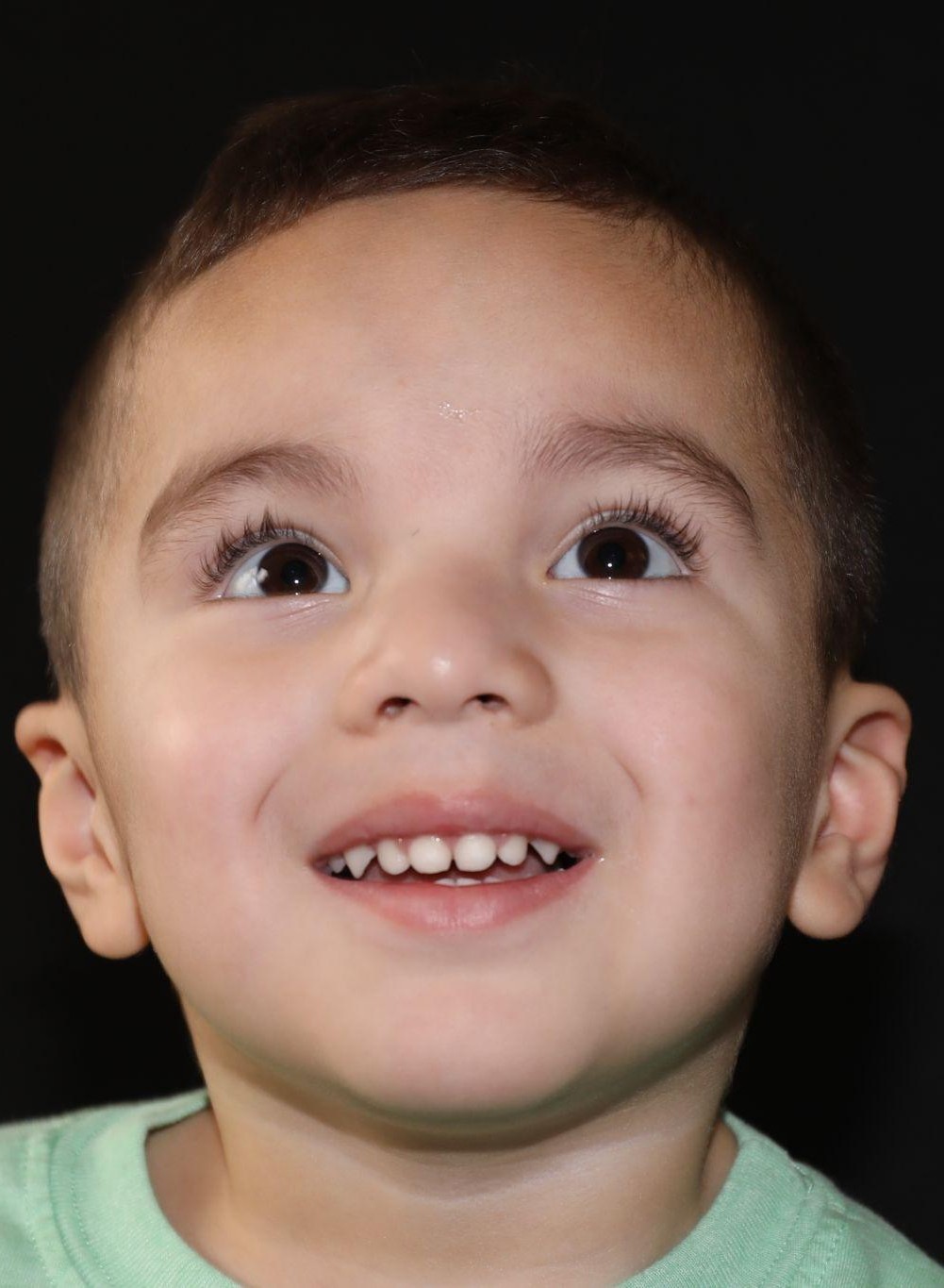 Chin at Year 4 after treatment - Case 1007
