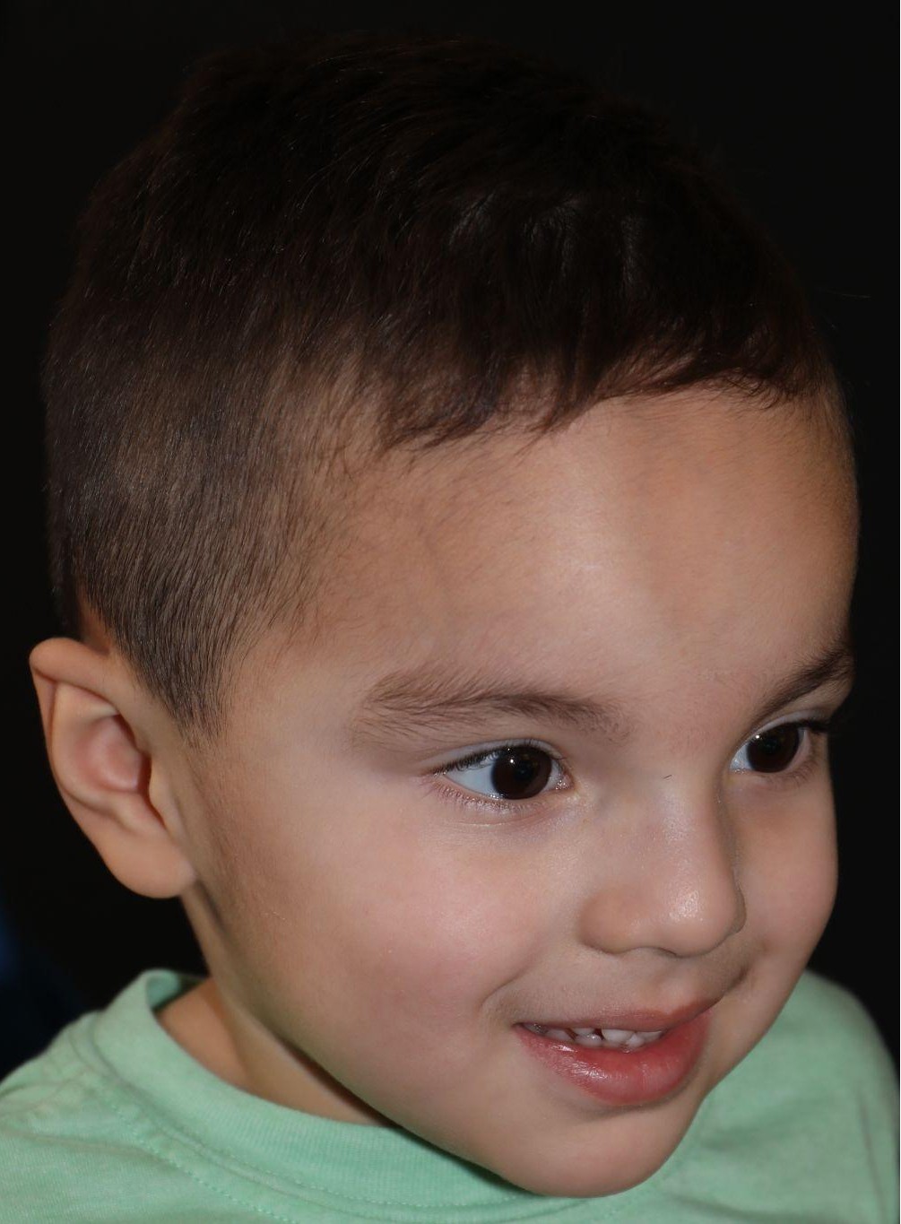 Right angle at Year 4 after treatment - Case 1007