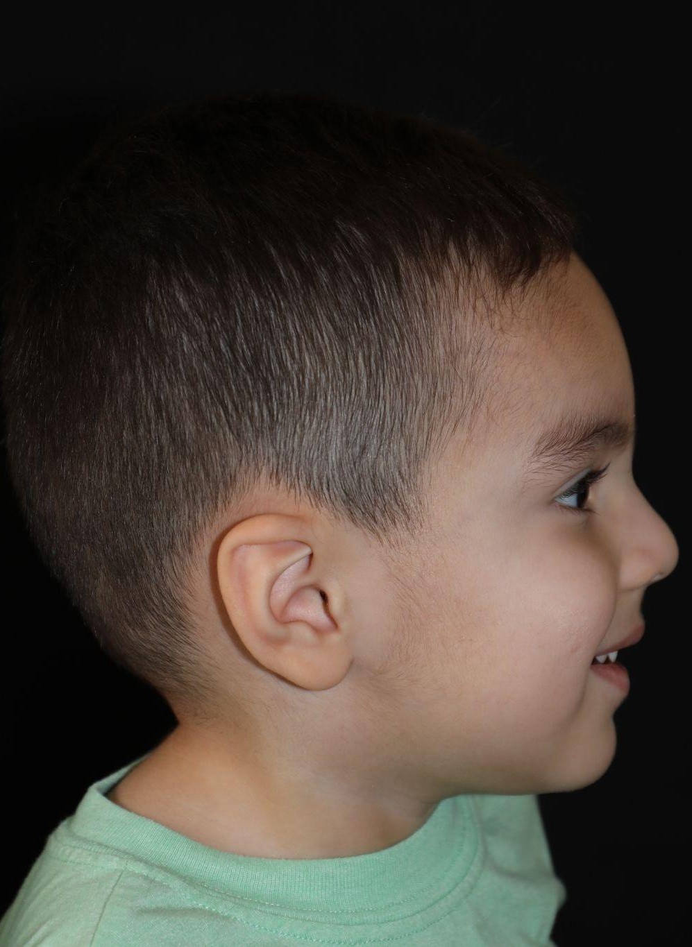 Right profile at Year 4 after treatment - Case 1007