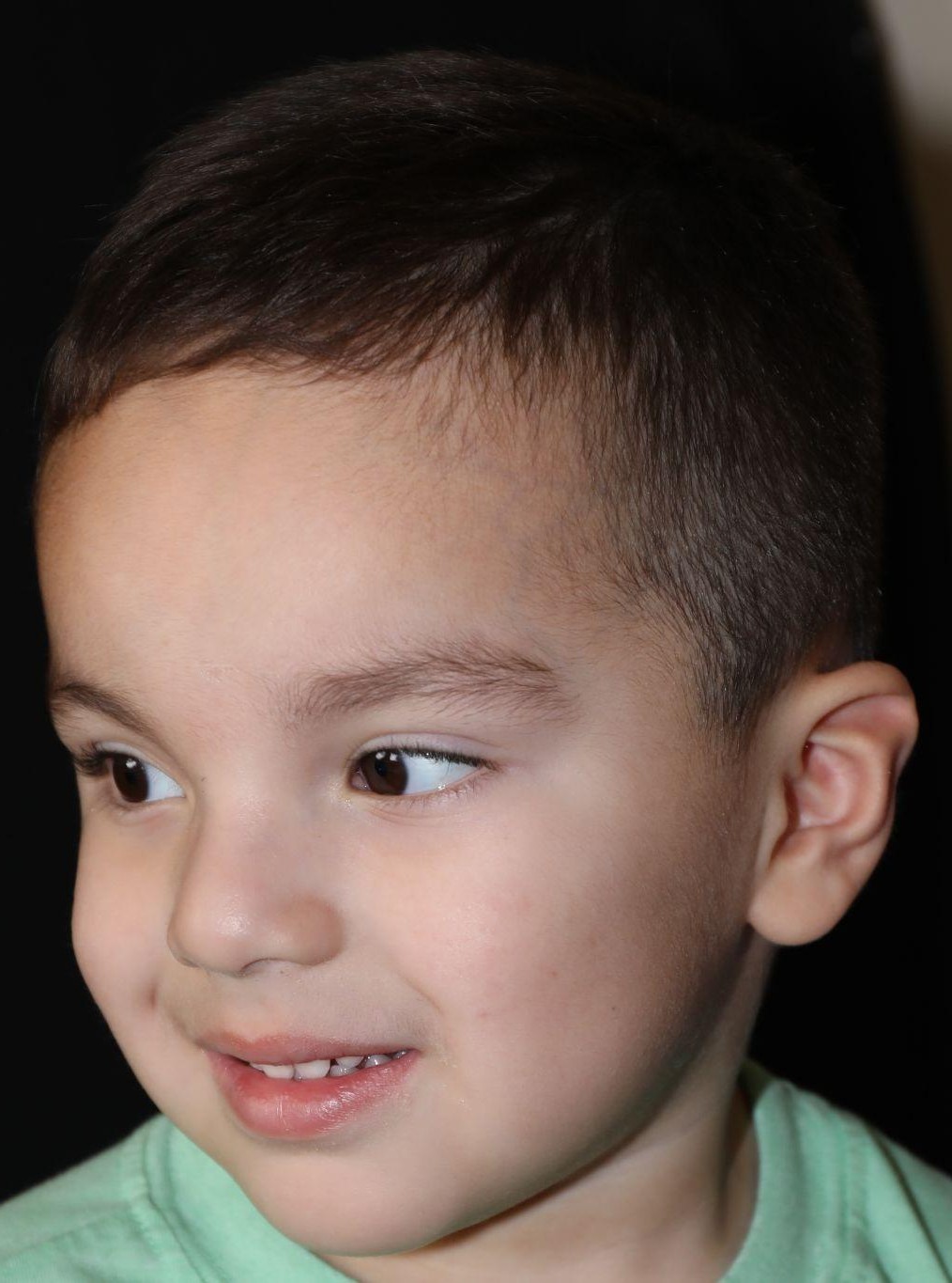 Left angle at Year 4 after treatment - Case 1007