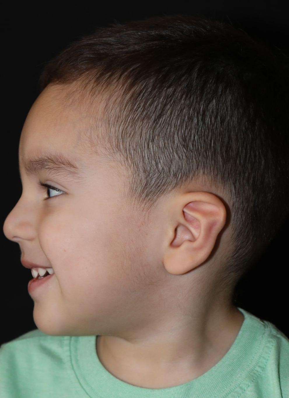 Left profile at Year 4 after treatment - Case 1007