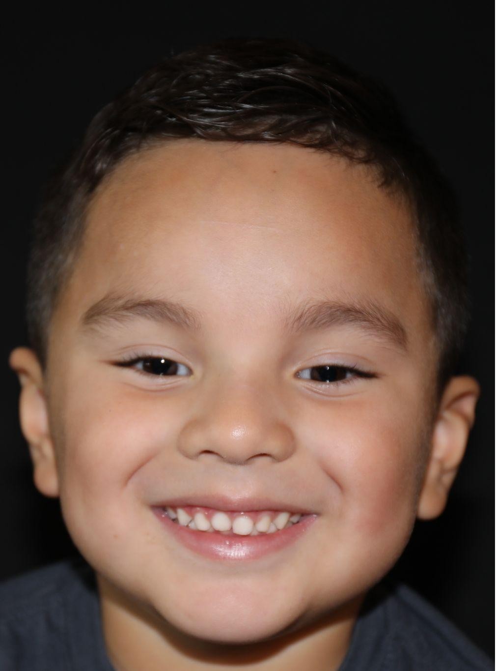 Front view at Year 5 after treatment - Case 1007