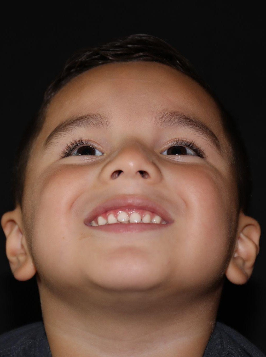 Chin at Year 5 after treatment - Case 1007