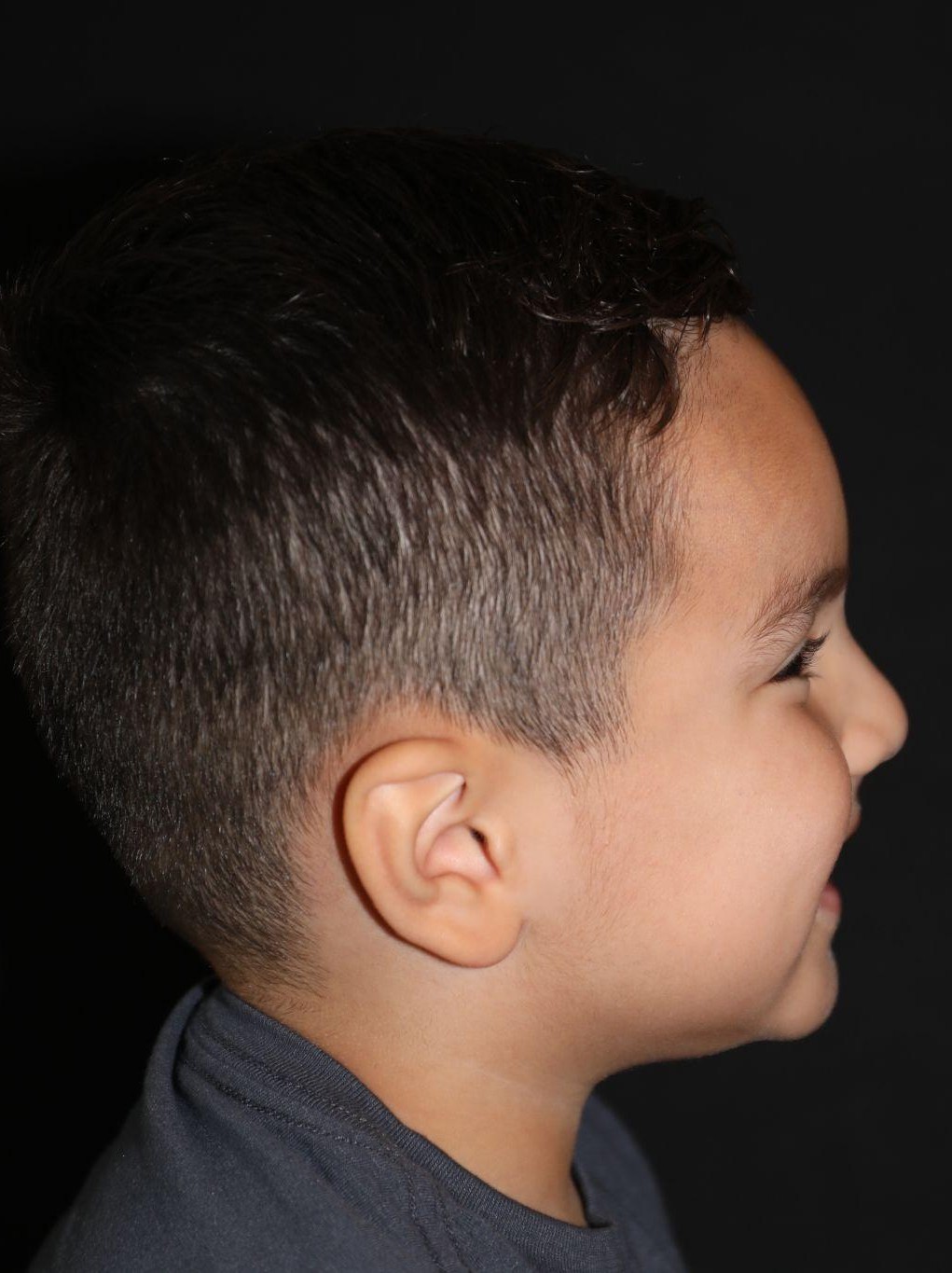 Right profile at Year 5 after treatment - Case 1007