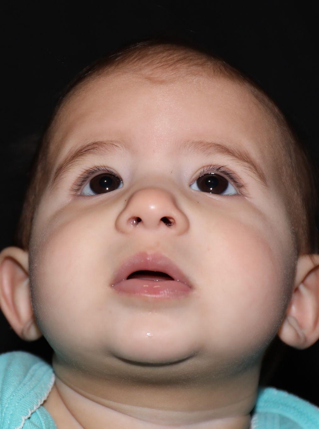 Chin before treatment - Case 1008
