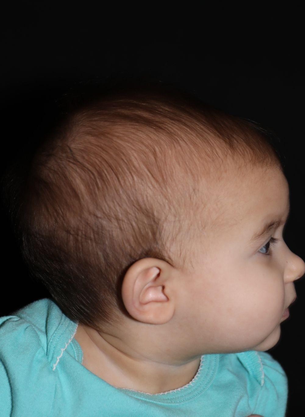 Right profile before treatment - Case 1008