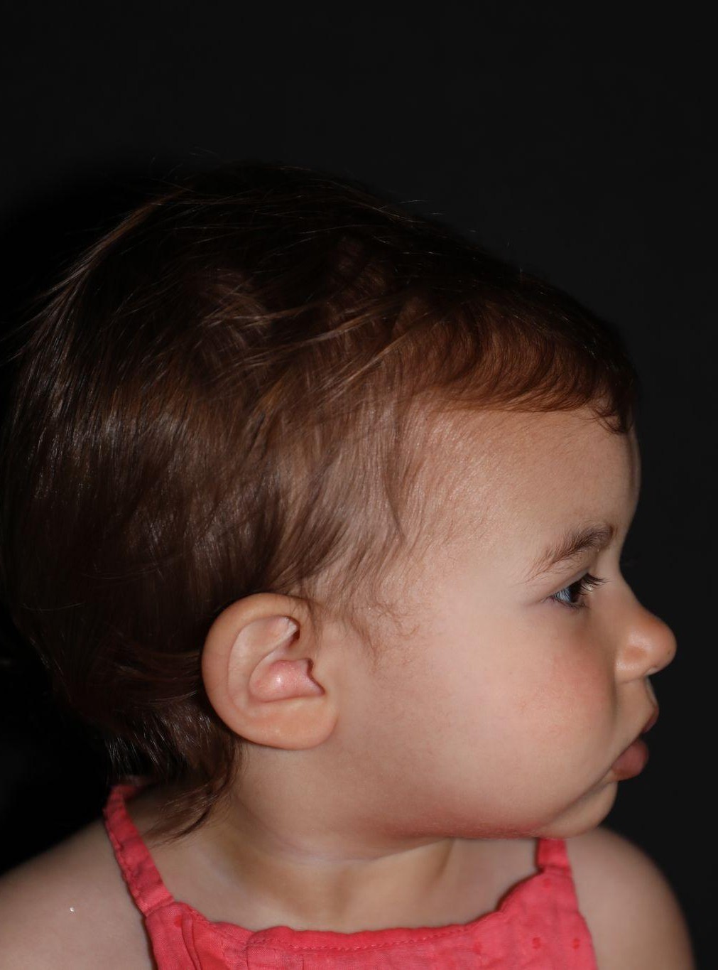 Right profile at Year 2 after treatment - Case 1008