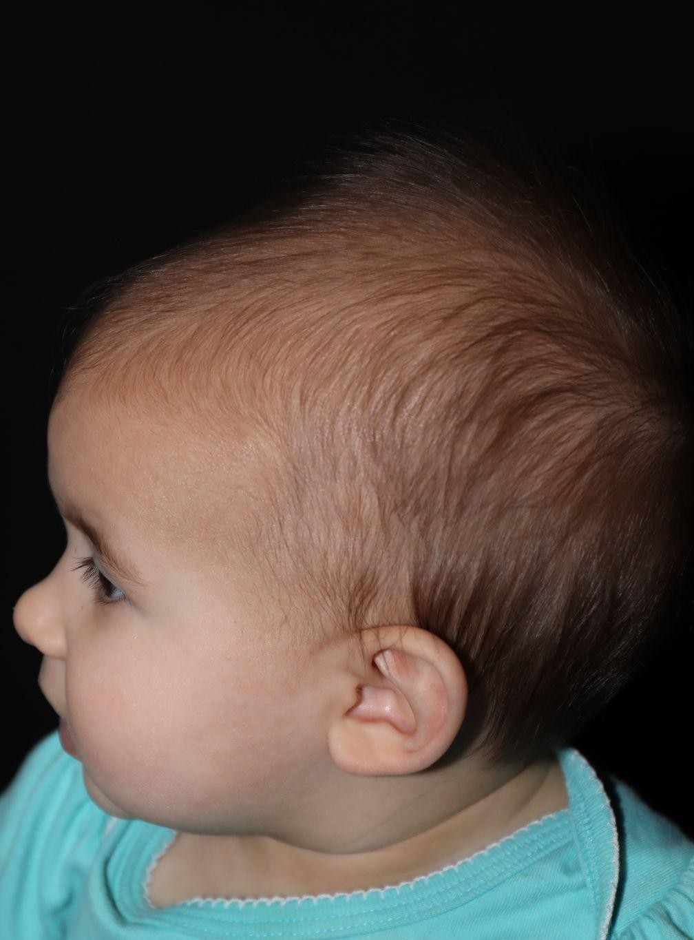 Left profile before treatment - Case 1008