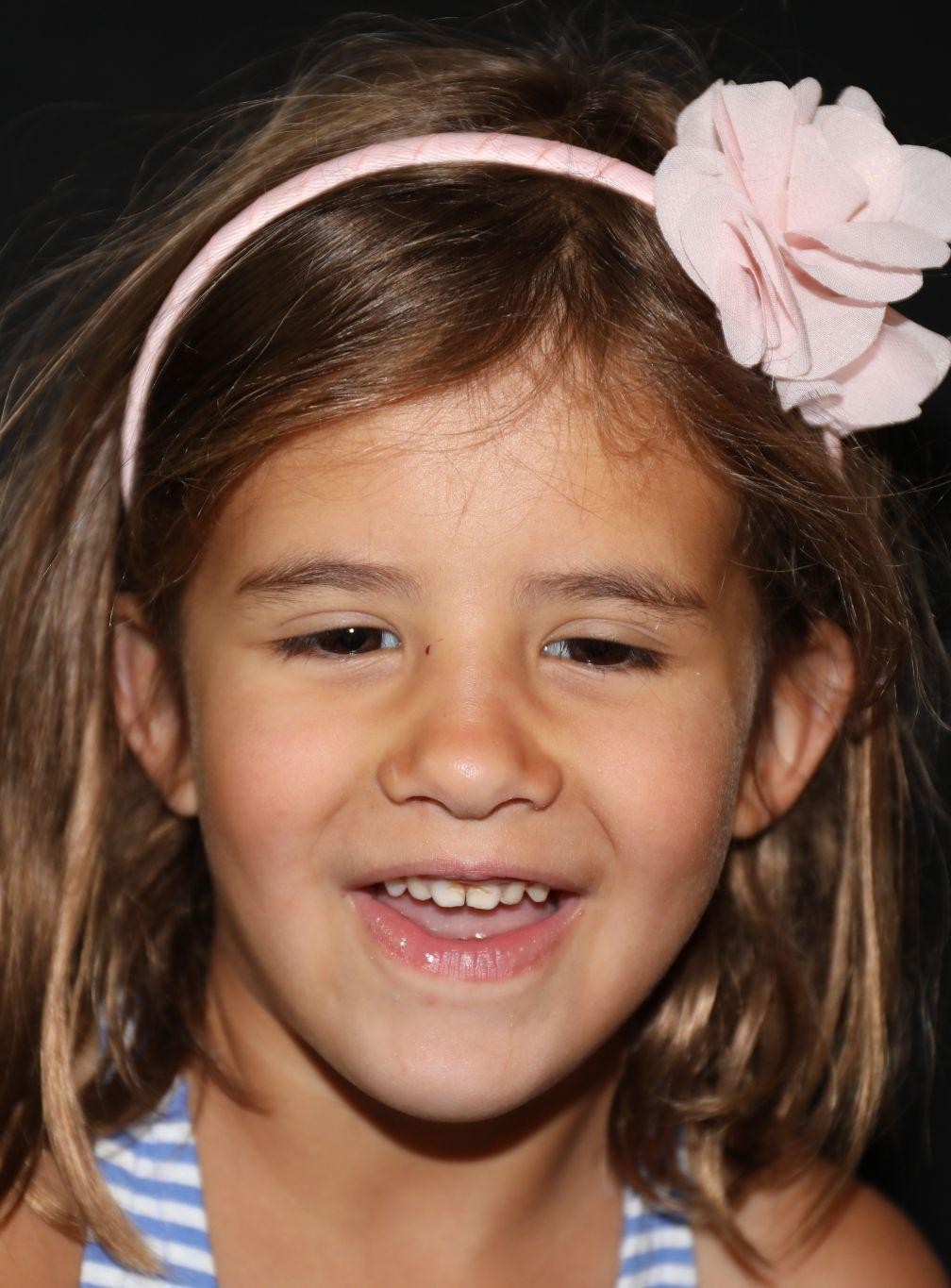 Front view at Year 4 after treatment - Case 1008