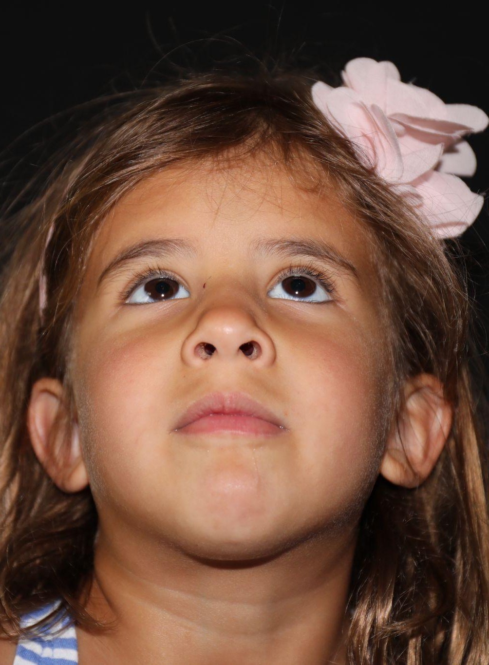 Chin at Year 4 after treatment - Case 1008
