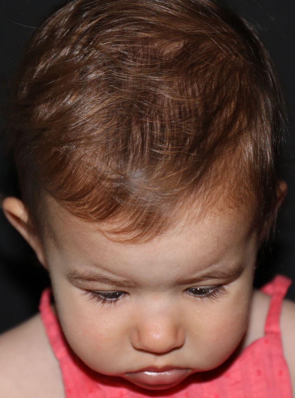 Top (vertex) at Year 2 after treatment - Case 1008