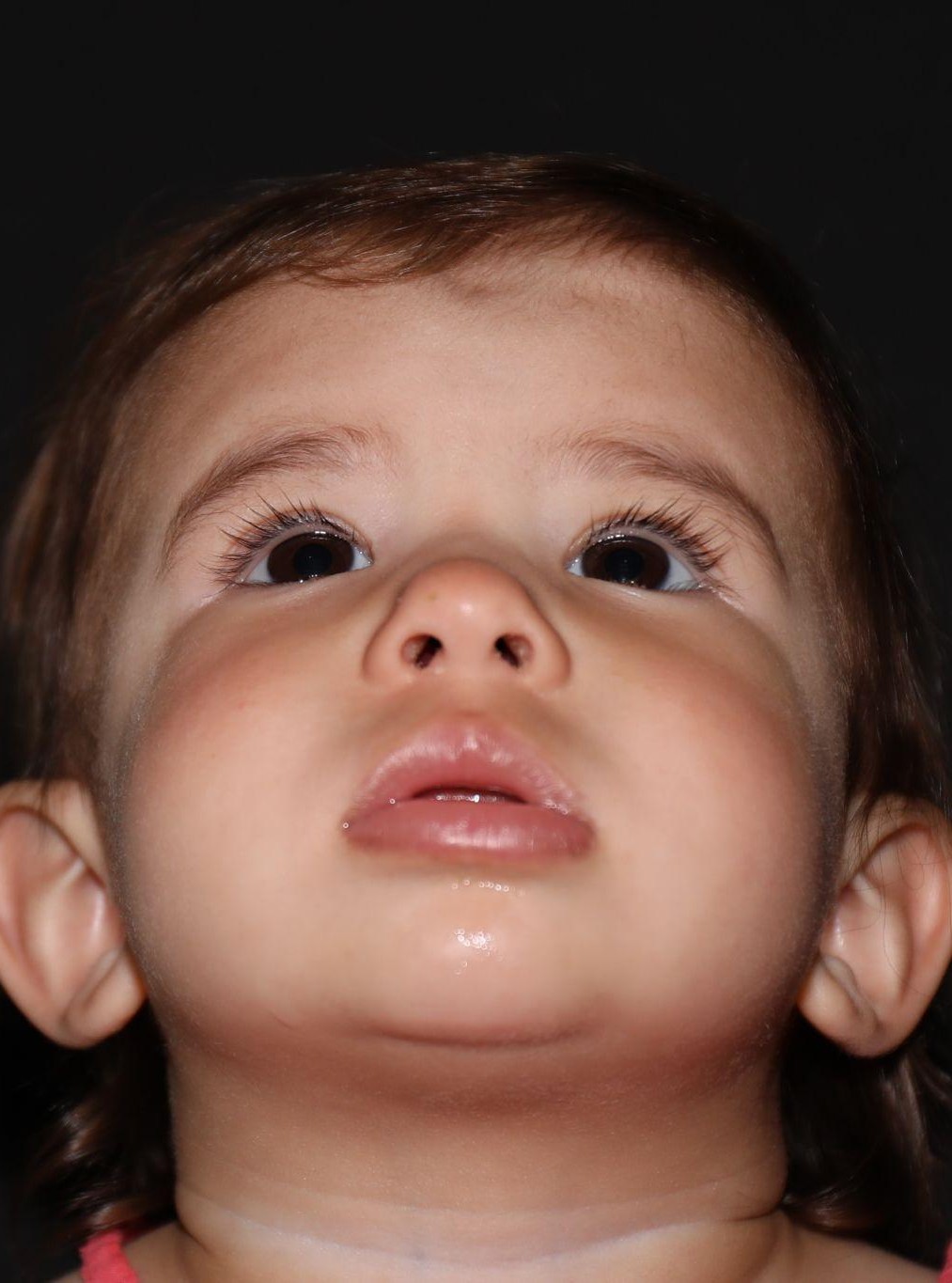 Chin at Year 2 after treatment - Case 1008