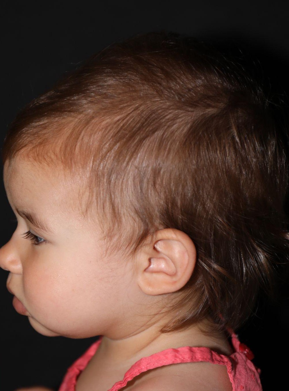 Left profile at Year 2 after treatment - Case 1008