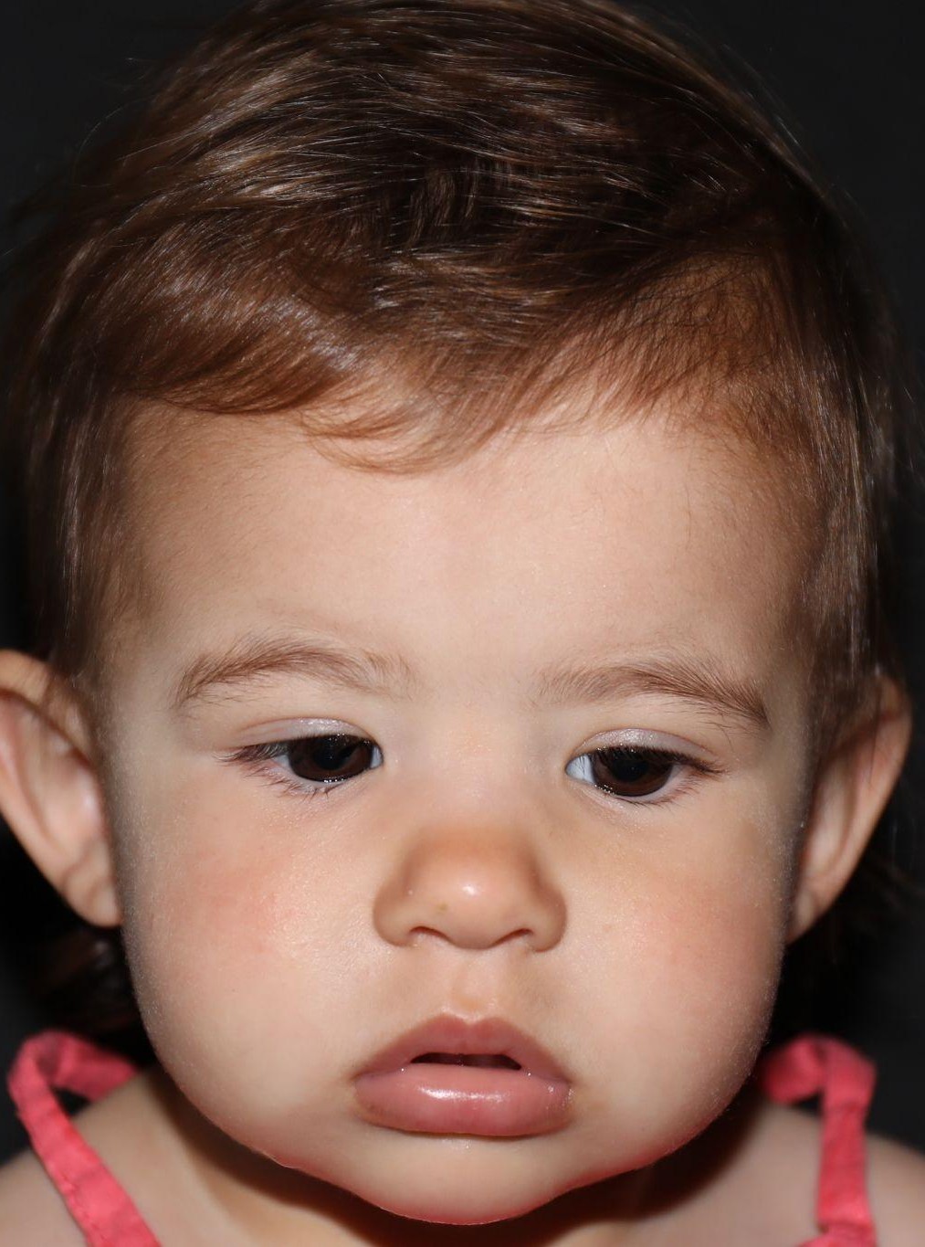 Front view at Year 2 after treatment - Case 1008