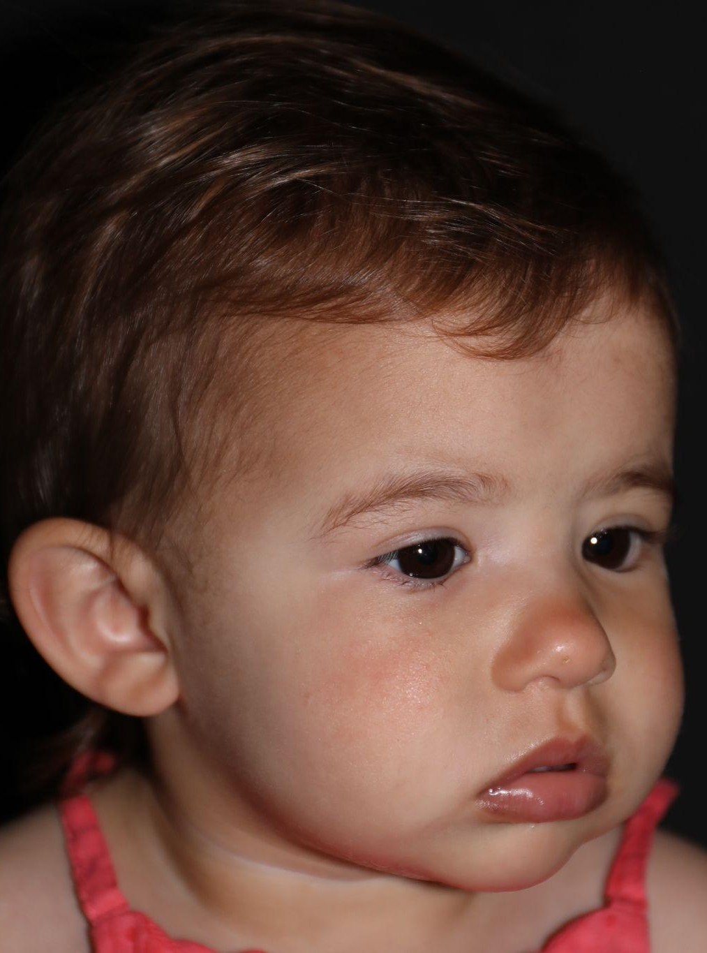 Right angle at Year 2 after treatment - Case 1008