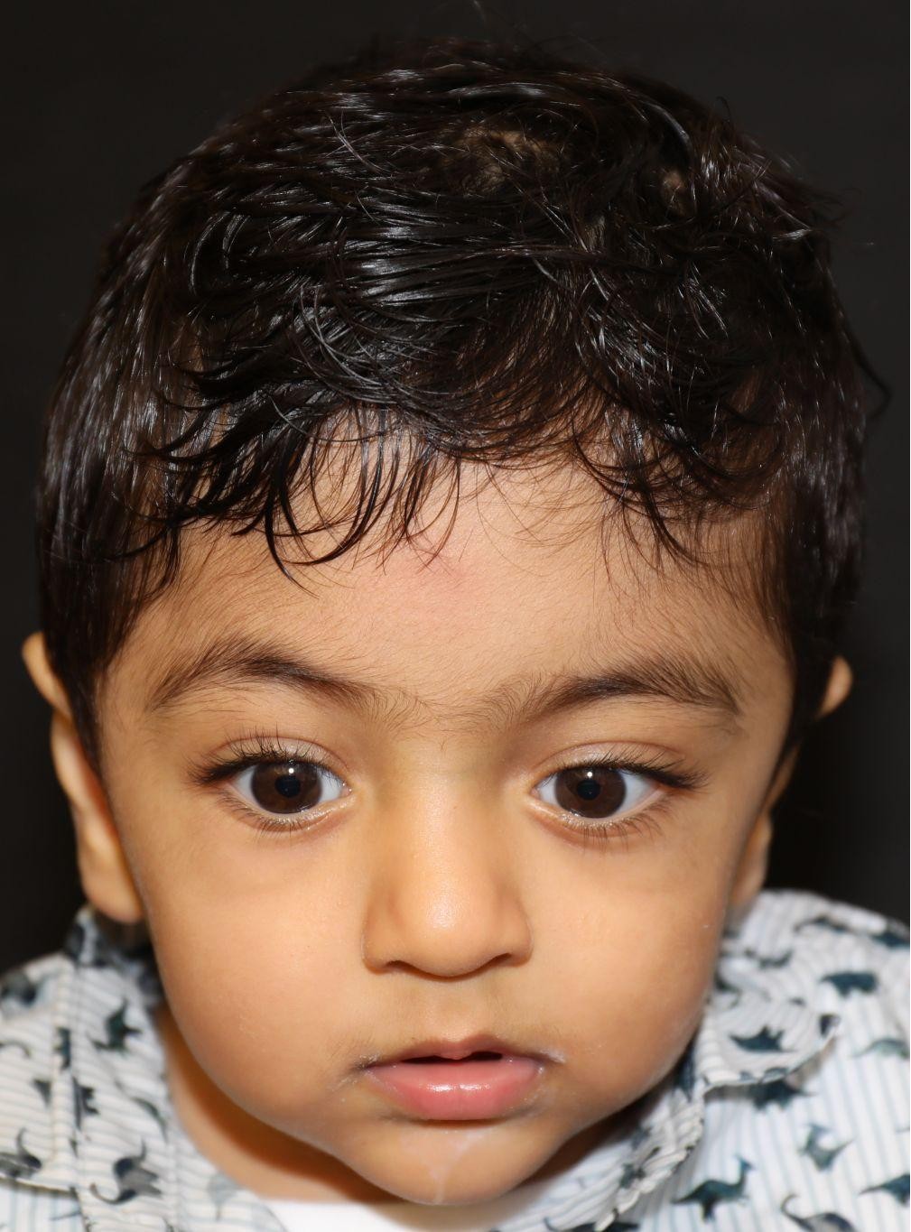 Front view at Year 3 after treatment - Case 1009