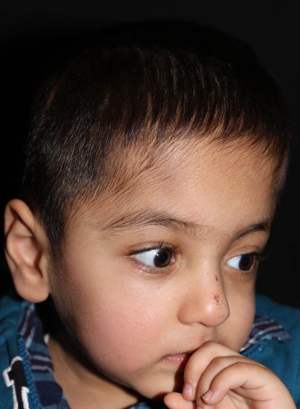 Right angle at Year 4 after treatment - Case 1009