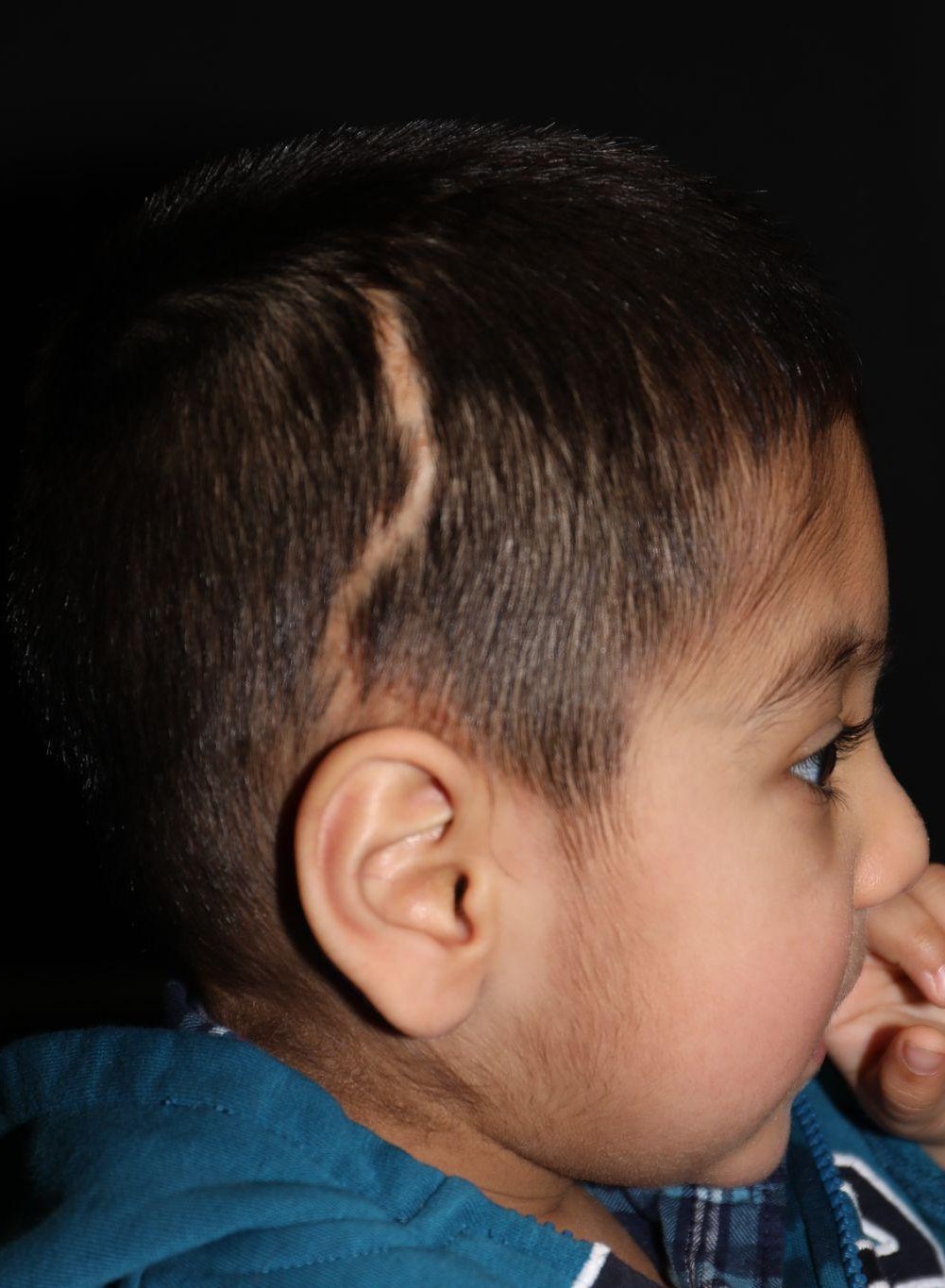Right profile at Year 4 after treatment - Case 1009