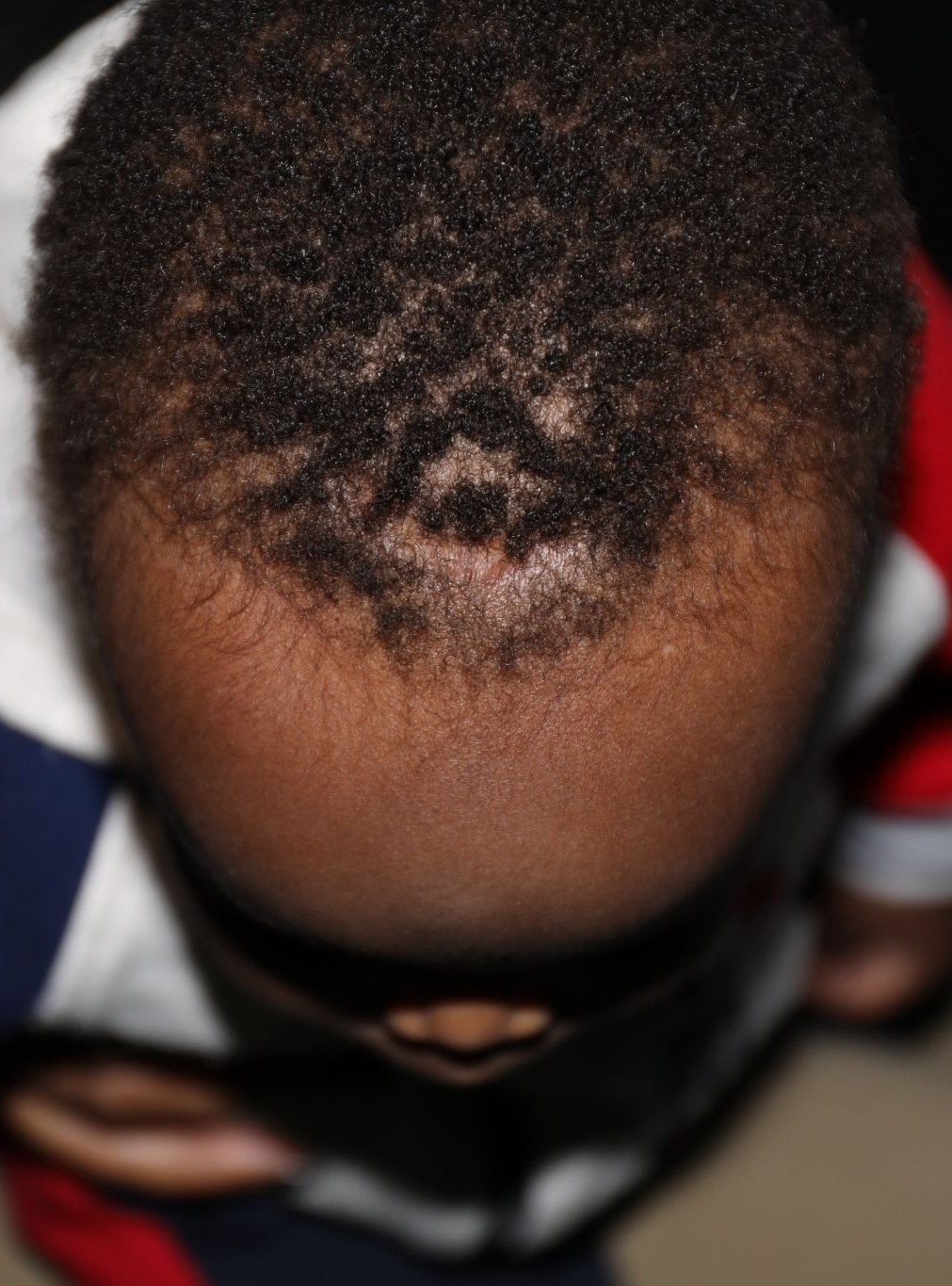 Top (vertex) at Year 2 after treatment - Case 1005