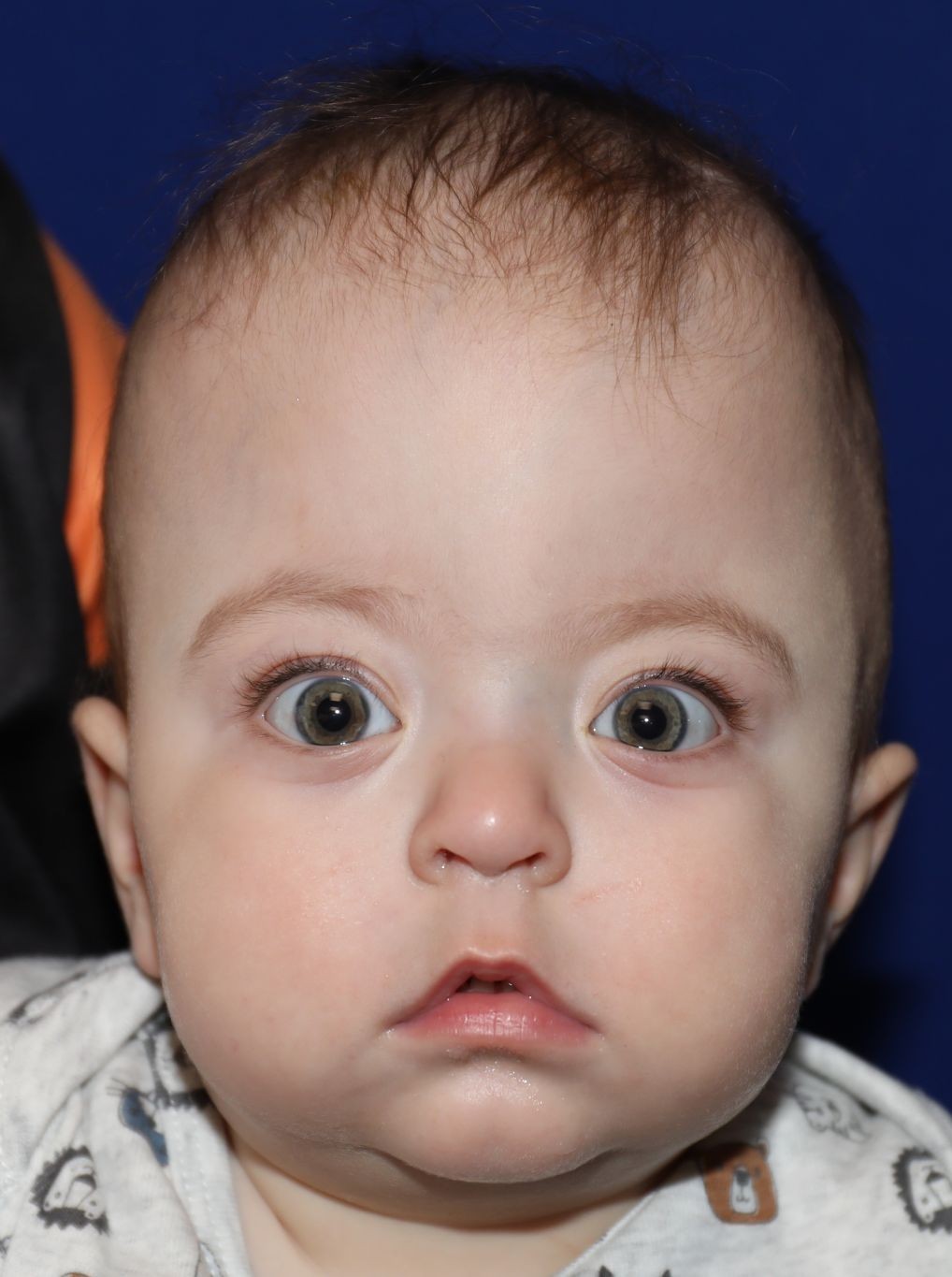 Front view before treatment - Case 1001