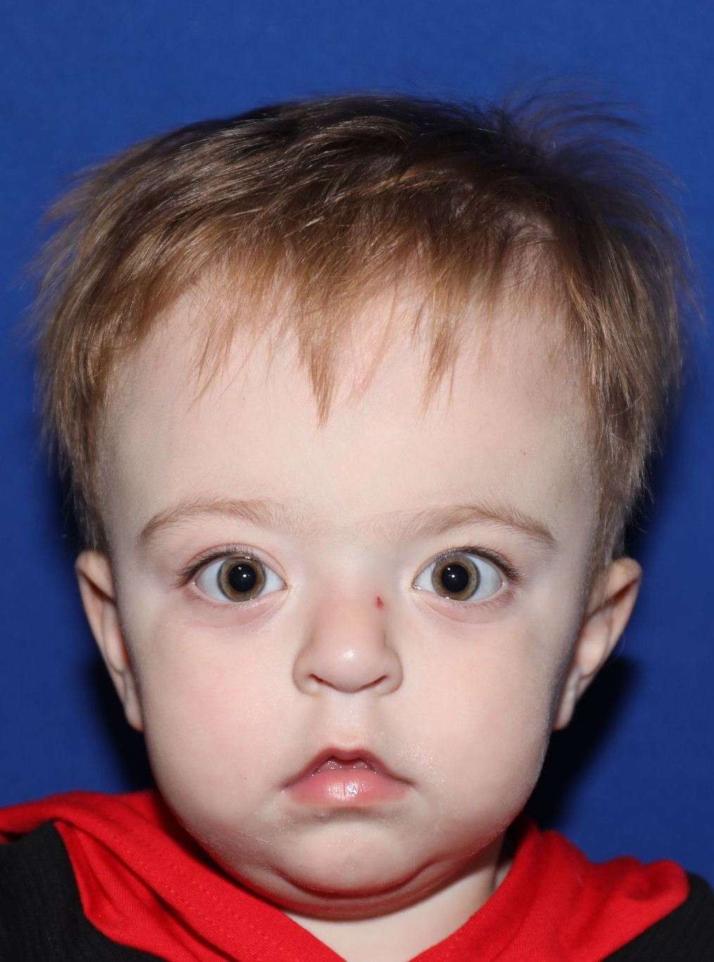 Front view at Year 2 after treatment - Case 1001