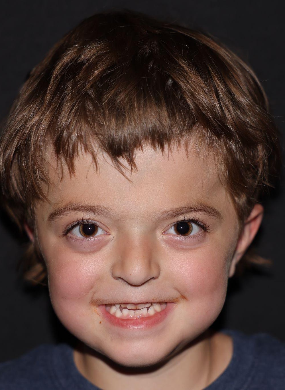 Front view at Year 3 after treatment - Case 1001