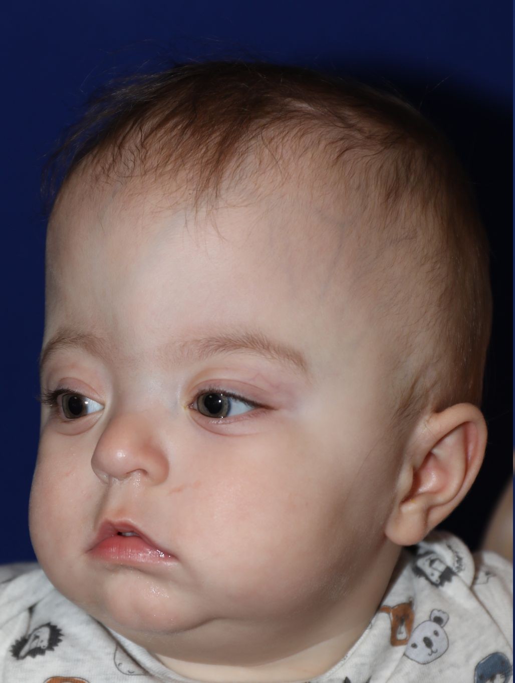 Left angle before treatment - Case 1001