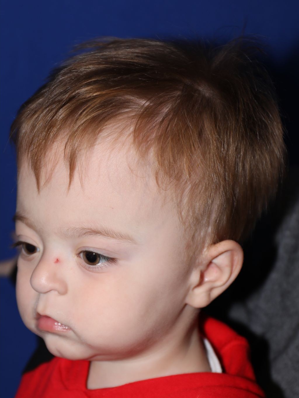 Left angle at Year 2 after treatment - Case 1001