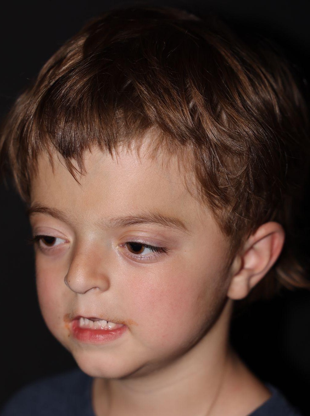 Left angle at Year 3 after treatment - Case 1001