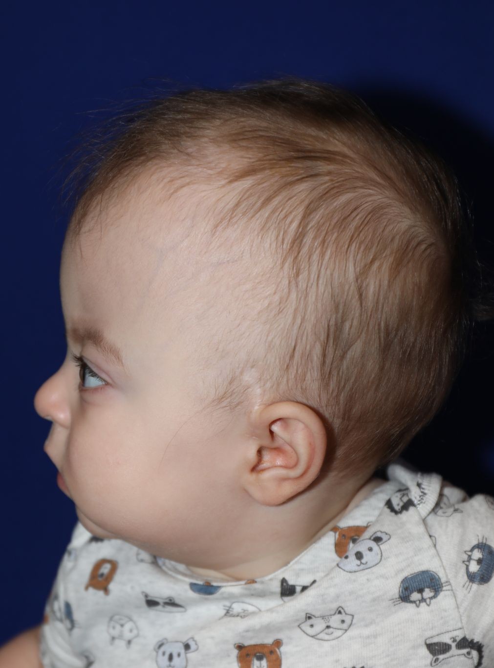 Left profile before treatment - Case 1001