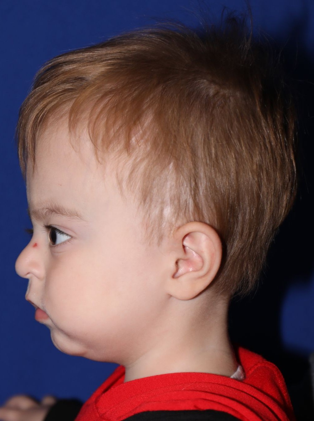 Left profile at Year 2 after treatment - Case 1001