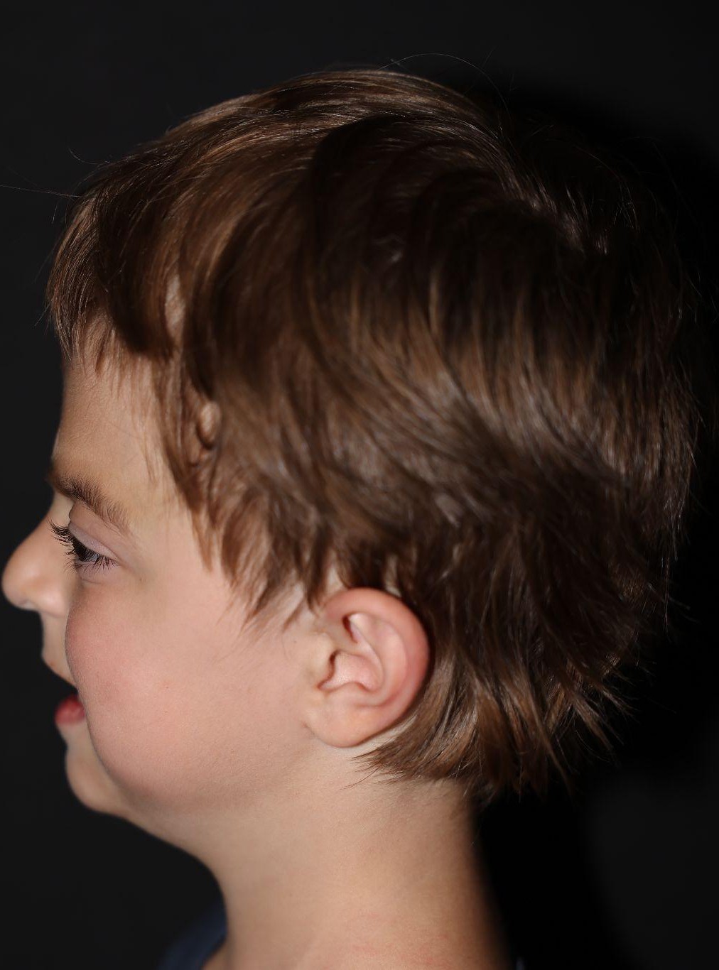 Left profile at Year 3 after treatment - Case 1001