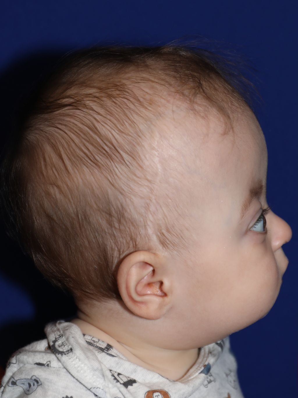 Right profile before treatment - Case 1001