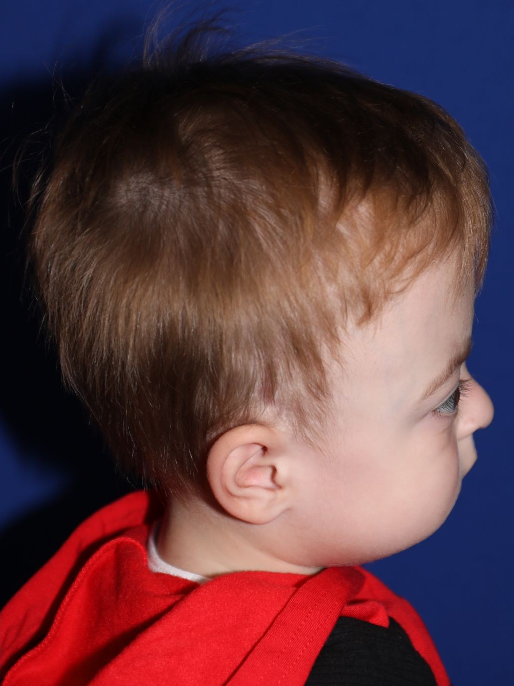 Right profile at Year 2 after treatment - Case 1001